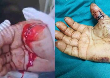 कटे अंगूठे को मिली नई ज़िंदगी, चंदन हॉस्पिटल ने रचा चिकित्सा का चमत्कार