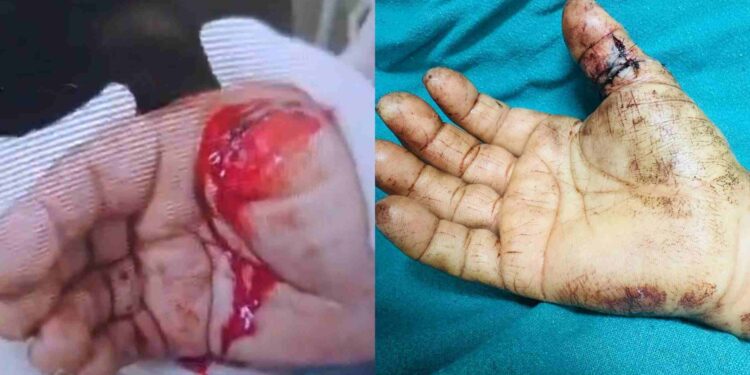 कटे अंगूठे को मिली नई ज़िंदगी, चंदन हॉस्पिटल ने रचा चिकित्सा का चमत्कार